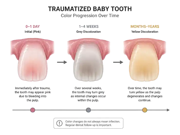 Illustration showing the color stages of a baby tooth after a fall.