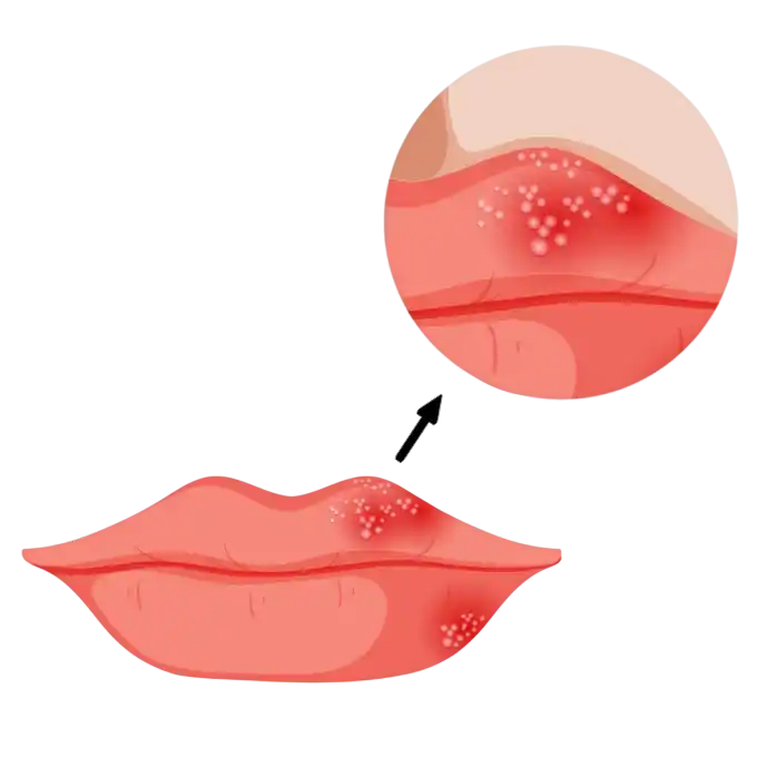 Illustration of a cold sore development stages