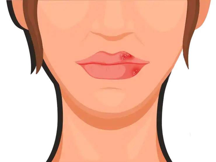 cold-sores key visual