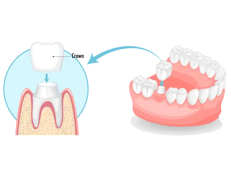 Illustration of dental crown on a tooth, showing how it covers the tooth structure.