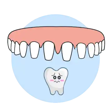 Illustration of multiple front teeth prepared for crowns, showing excessive tooth structure removal.