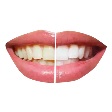 Image of comparison between a tooth before and after professional whitening.