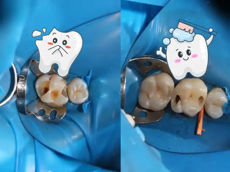 Image comparing a healthy tooth with a small filling to a tooth with a large filling, showing the difference in structure.