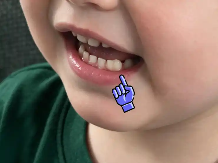 Display of a child's mouth with a pointer indicating a fused baby tooth in the lower jaw where the lateral incisor and canine meet.