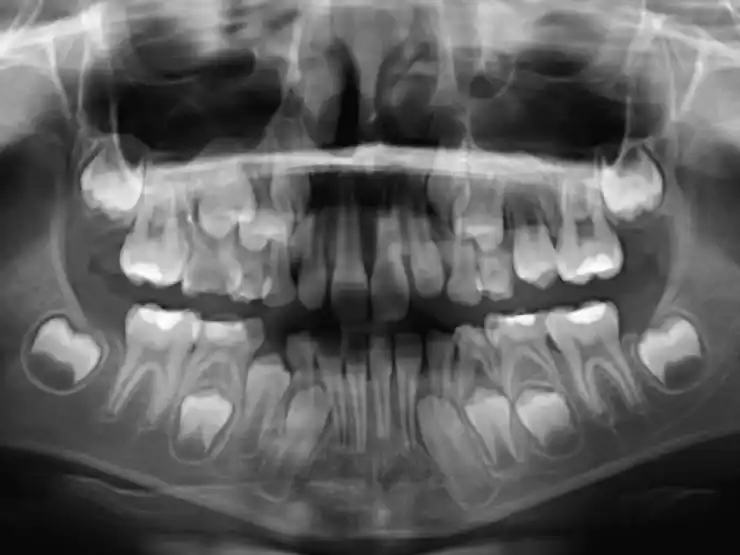 X Ray of whole mouth of a child in the mixed dentition stage, showing baby teeth and its successor teeth that are developing and underneath.