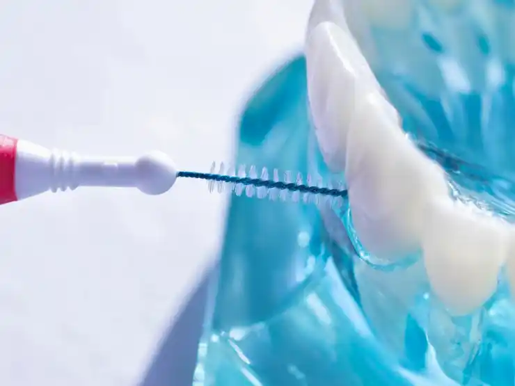 Illustration of brushing with an interdental brush on a model of teeth.