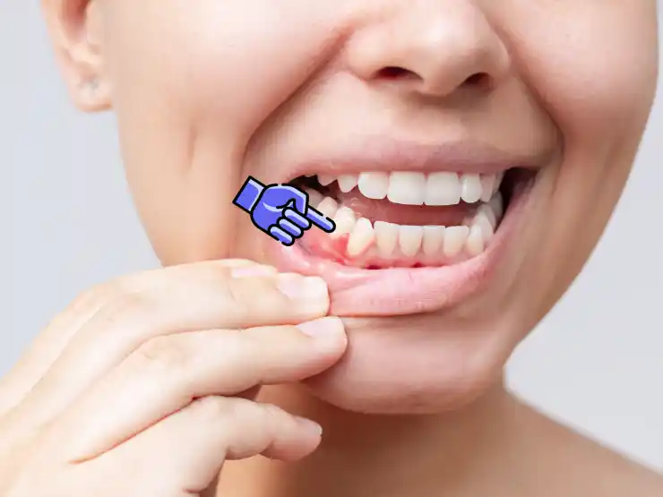 Woman showing inflamed gums on the lower right side with a dental glove pointing to the area.