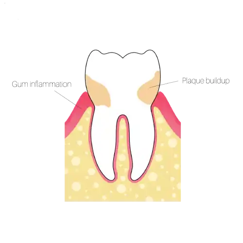 Illustration of dental plaque as a sticky film of bacteria and food debris on the tooth surface near the gum line.