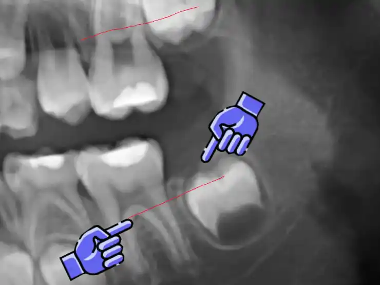 X-ray illustration of a first permanent molar and the developing second molar beside it, with pointers marking the root bifurcation and the point where the second molar's crown has passed it.