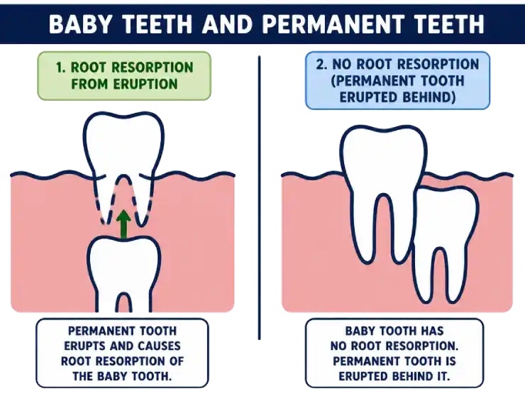 Illustration showing the process of root resorption in baby teeth as a permanent tooth erupts underneath.