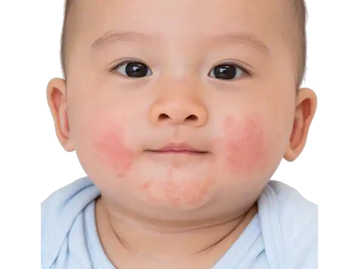 Baby with a teething rash on cheeks and chin, showing red and irritated skin around the mouth area
