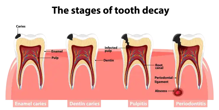 Illustration of tooth decay stages from enamel decay to deep decay reaching the nerve