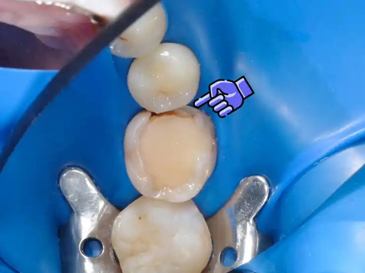 Teeth close-up from bird eye view showing a cracked filling on one tooth