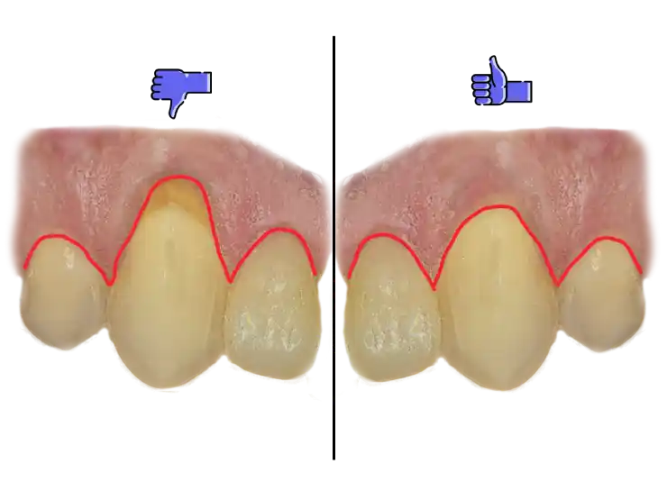 Teeth close-up left side showing receding gums and right side showing normal gums.