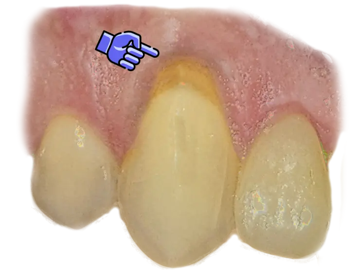 Teeth close-up showing receding gums exposing the neck of the tooth.