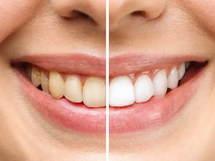 Mouth close-up showing teeth where left side is before whitening and right side is after whitening