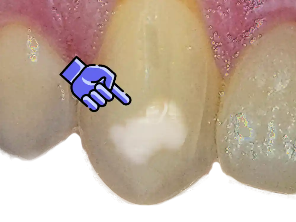 Tooth close-up showing white spot on tooth surface