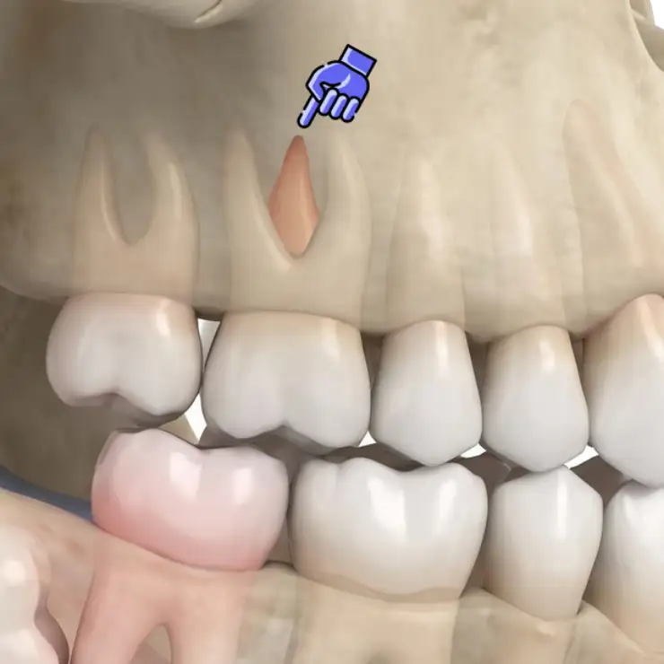 3D illustration showing the palatal root of the upper first molar in close proximity to the maxillary sinus