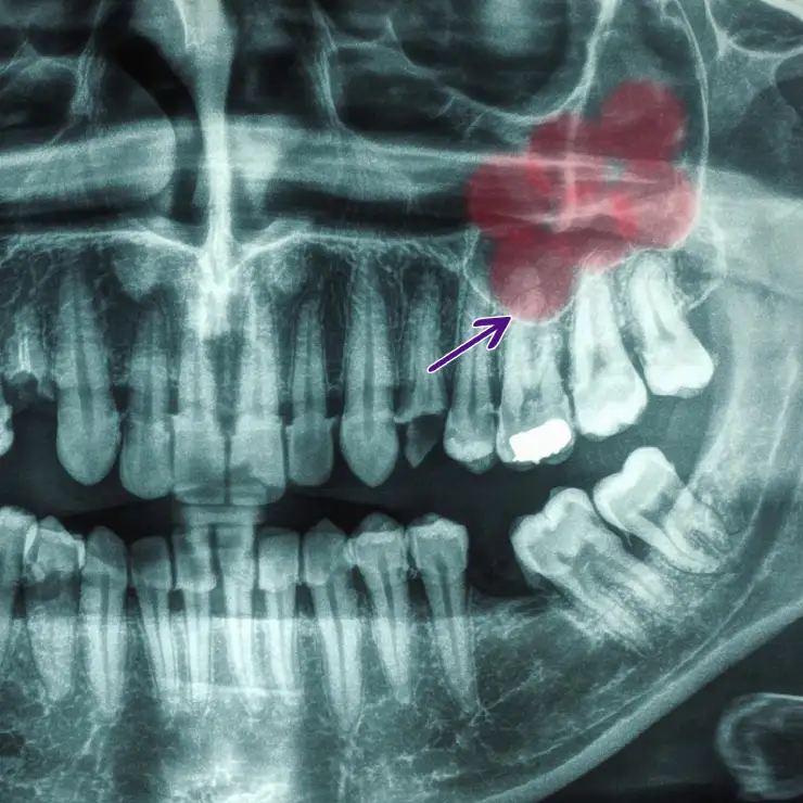 X-ray showing a close relationship between the upper molar roots and the maxillary sinus